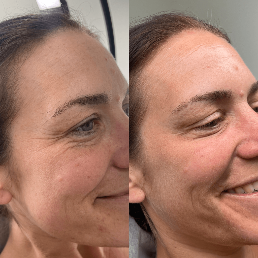 Botox Kråksparkar före & efter