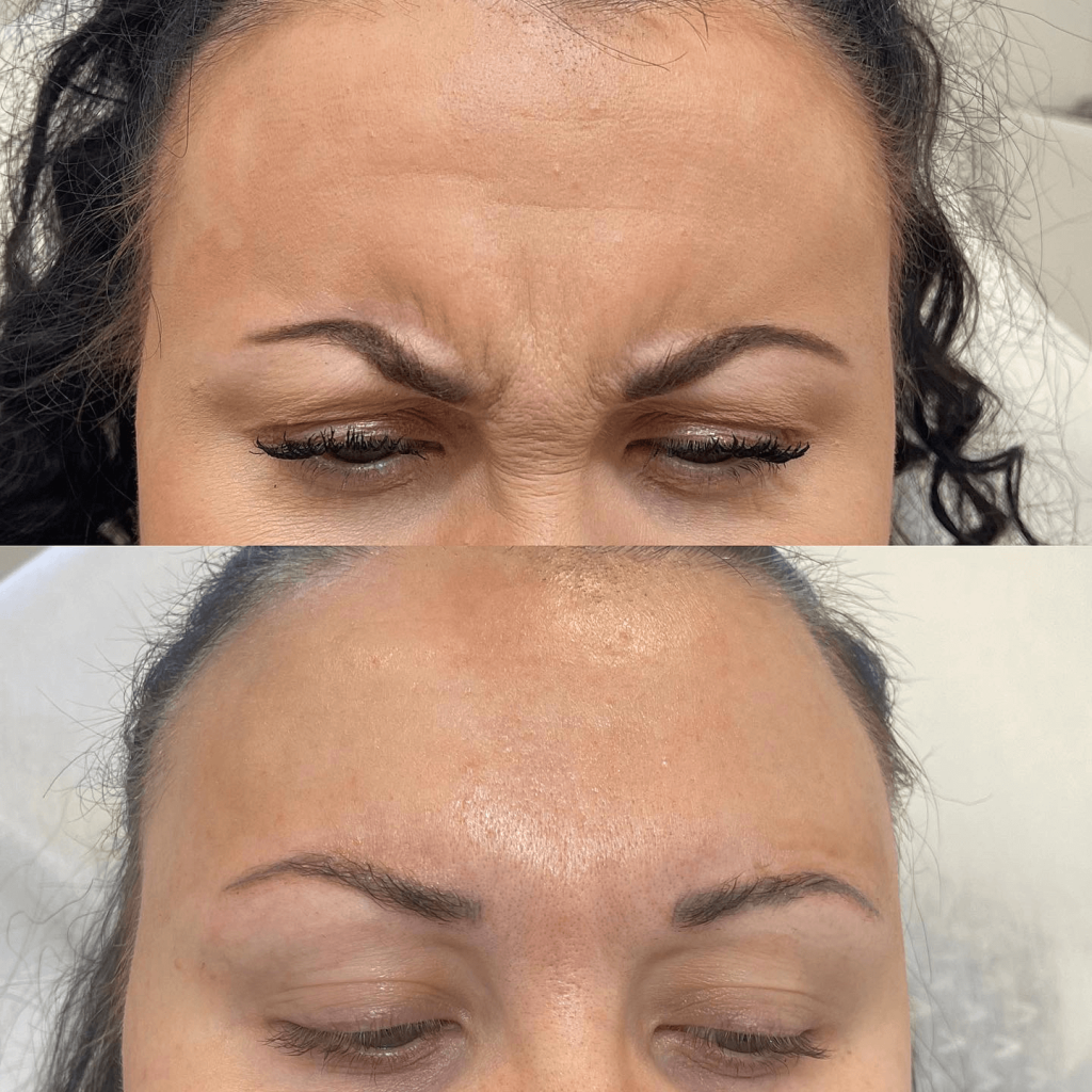 Botox Arga rynkan före & efter