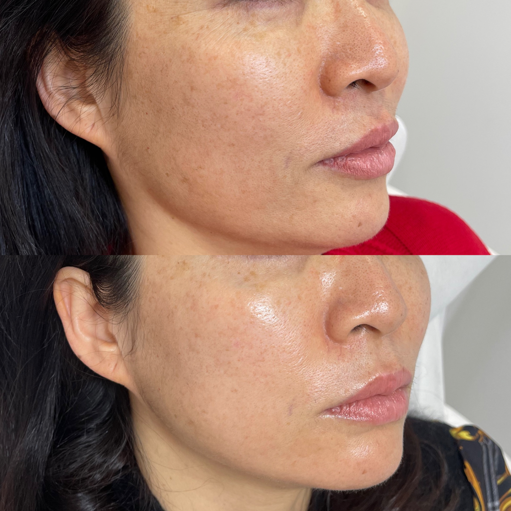 Sculptra kurs