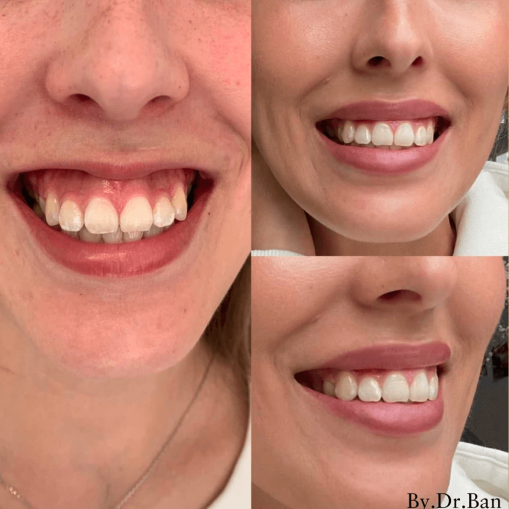 Gummy smile före & efter