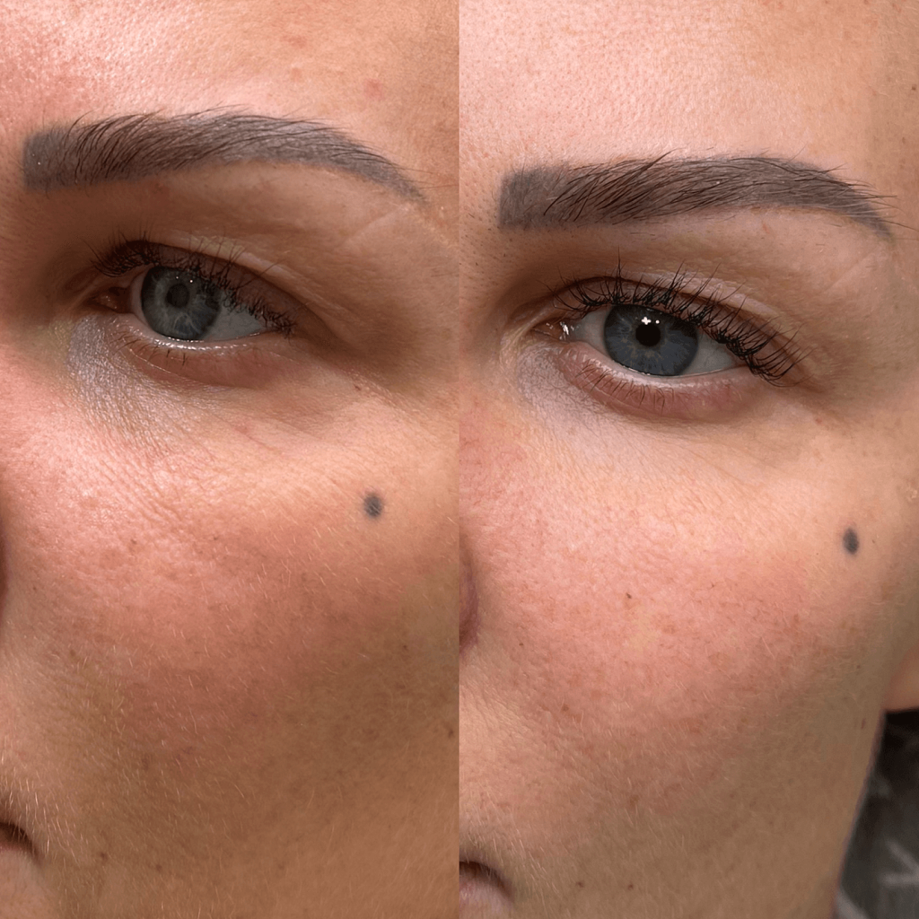 Skinbooster före & efter